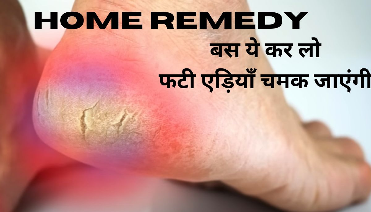 Hills Home remedy: फटी एड़ियों को ठीक करने के घरेलू नुस्खे